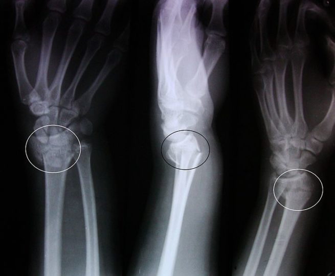 colles fracture osteoporosis