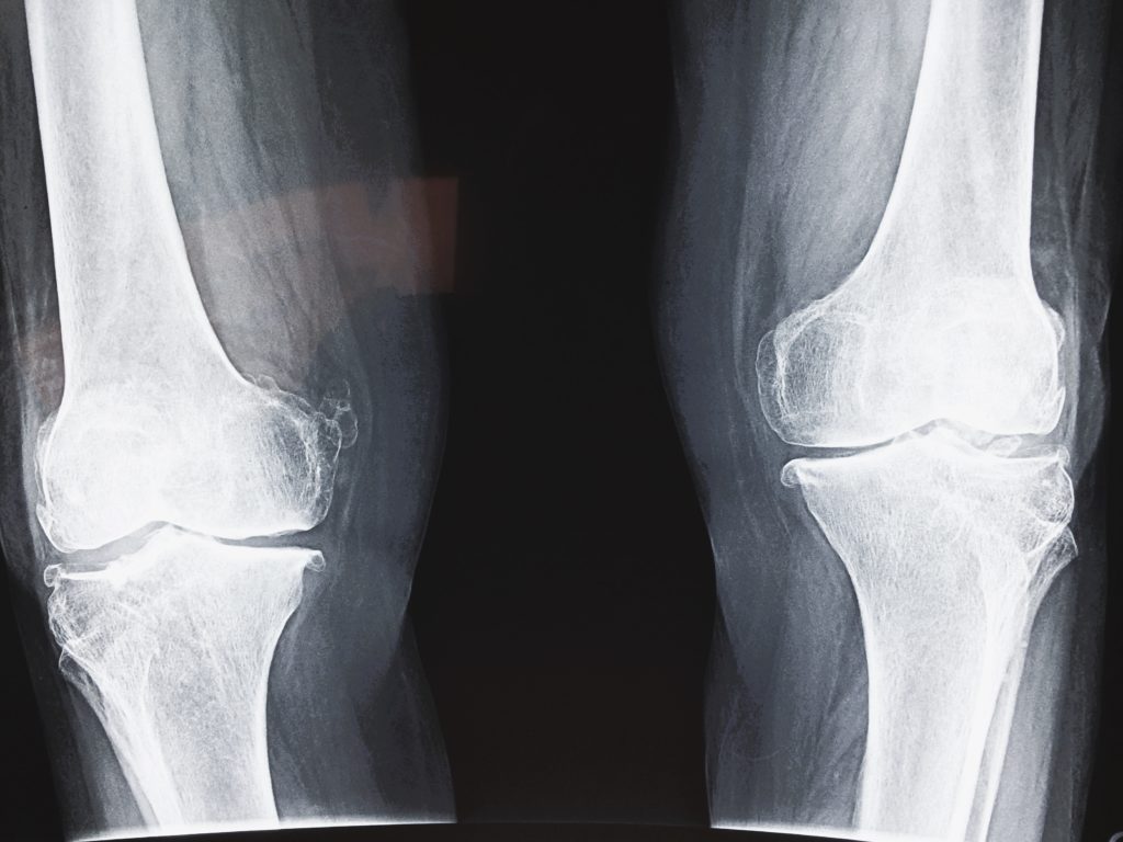 Artrosis de cadera y rodilla ¿En qué consiste? - Tratamiento en  FisioClinics Palma